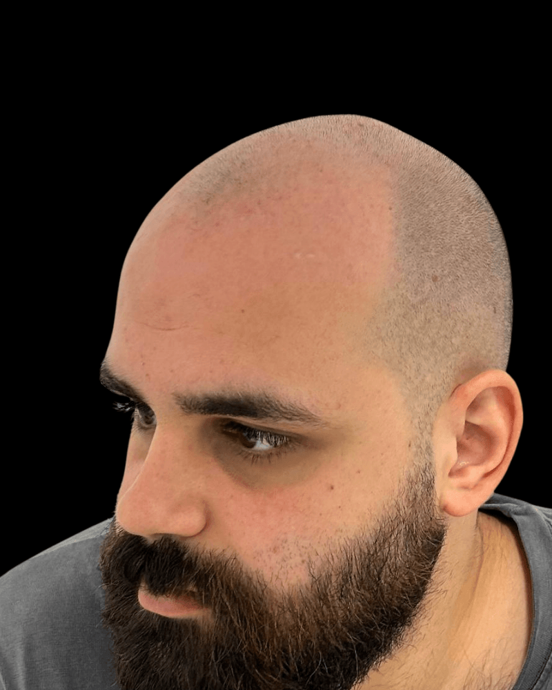 Antes de micropigmentación capilar — efecto rapado en Puente Genil