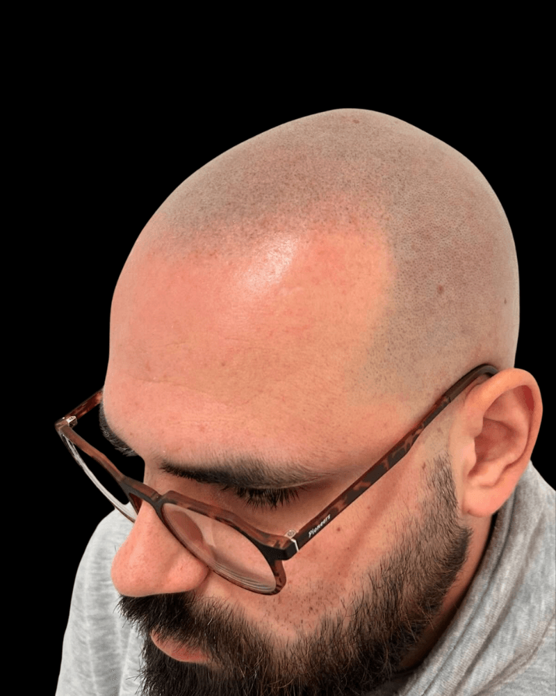 Después de micropigmentación capilar — efecto rapado en Puente Genil